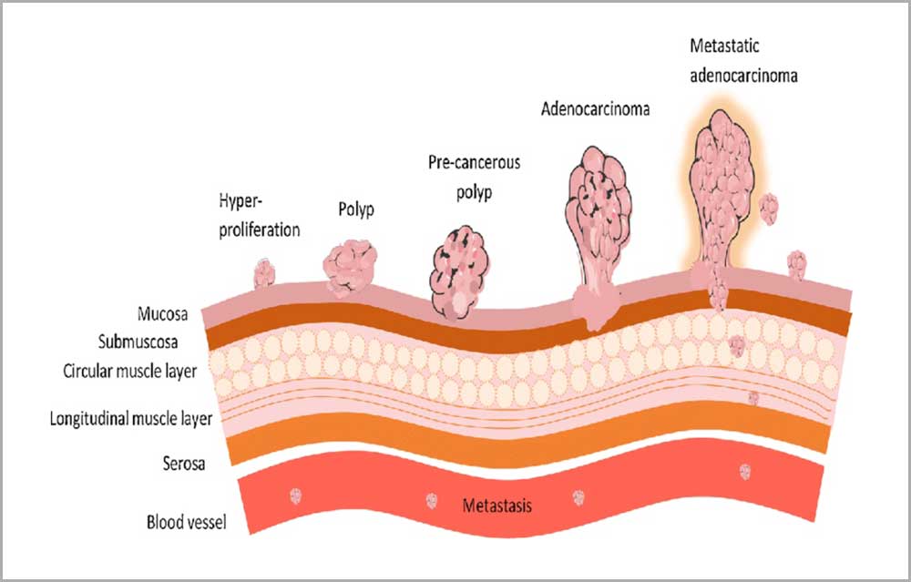 Stages-of-colorectal-cancer-Hype.jpg